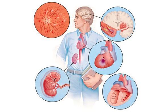 Danni a organi diversi con ipertensione arteriosa più lunga