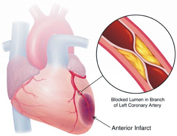 Una delle complicanze della pressione alta è la malattia cardiaca della malattia coronarica